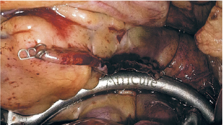 肺静脈の周りのアブレーション左の針金状のものは切除した左心耳の縫合部